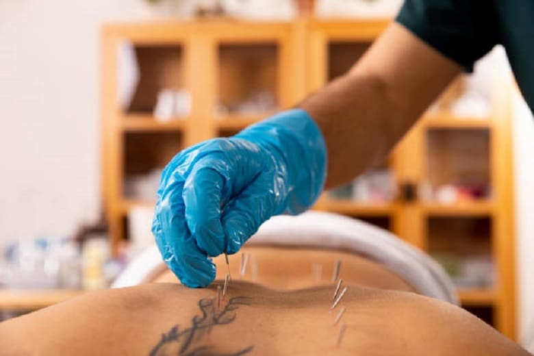 A person receiving acupuncture treatment for back pain.