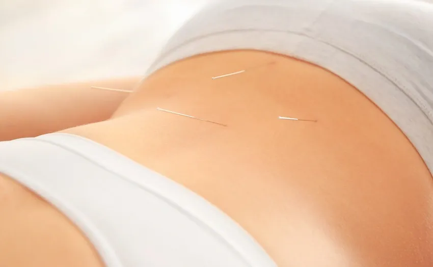 A woman undergoing acupuncture for healthy weight reduction with needles on her stomach.
