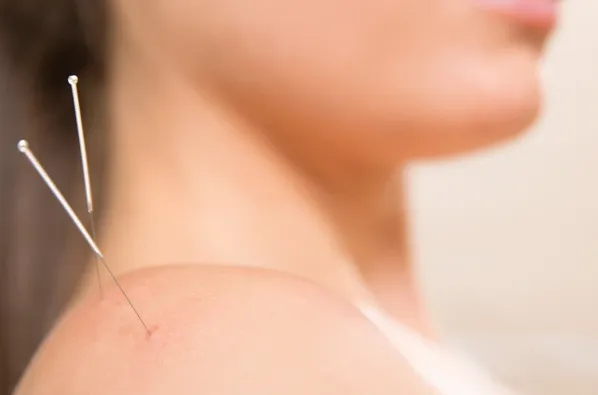 A woman with acupuncture needles on her shoulder receiving treatment for neck pain.