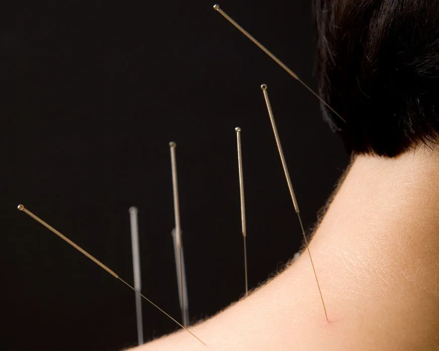 A woman experiencing relief from neck pain through acupuncture needles.