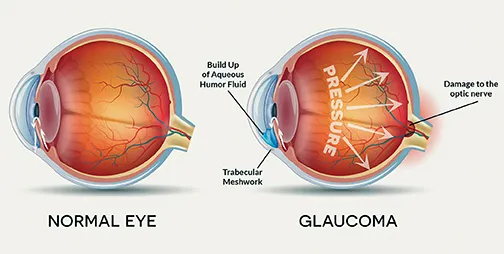 The impact of Glaucoma on both patients and normal eye.