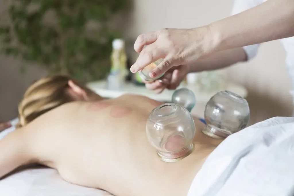 A woman getting a massage with glass jars on her back.
