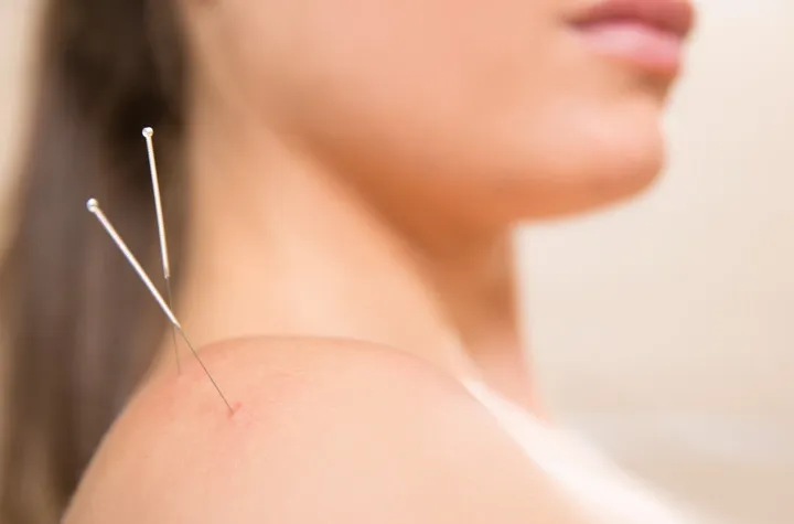 A woman with acupuncture needles relieving arthritis in her shoulder.