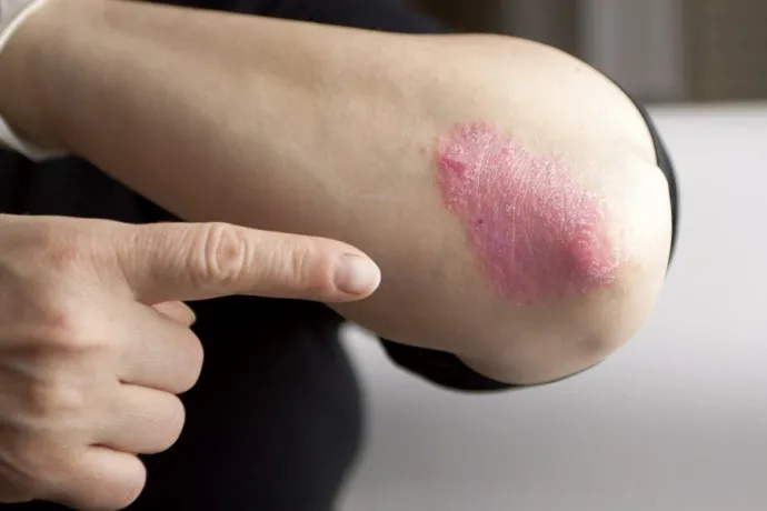 A person pointing at a psoriasis spot on their arm.