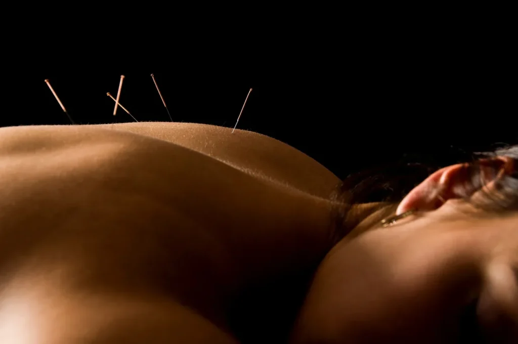 A woman receiving acupuncture treatment.