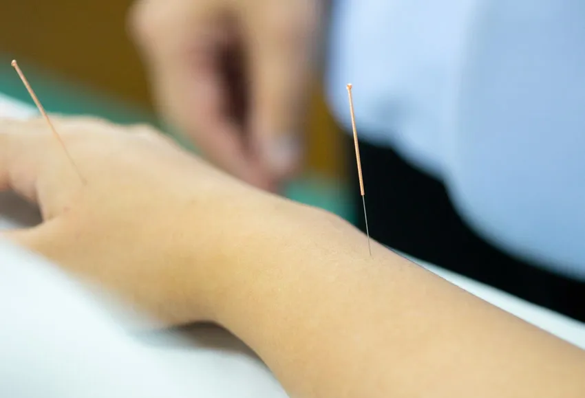 An acupuncture needle being placed on a person's arm to alleviate neuropathy.