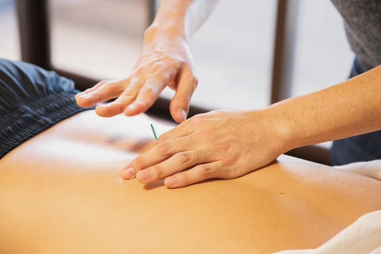 A woman receiving acupuncture for weight loss on her back.