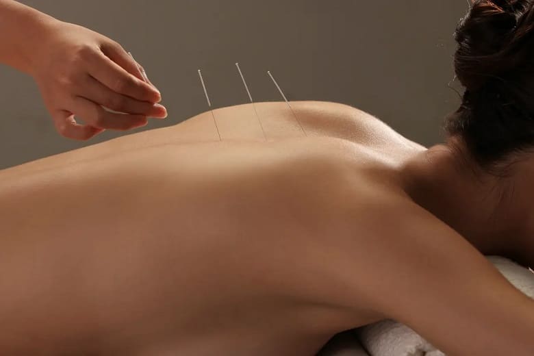 A woman receiving acupuncture on her back for pain relief.