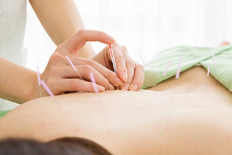 Acupuncturist applying needles to a patient's back during a therapy session.