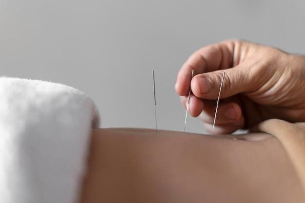 Practitioner inserting acupuncture needles into a patient's skin.