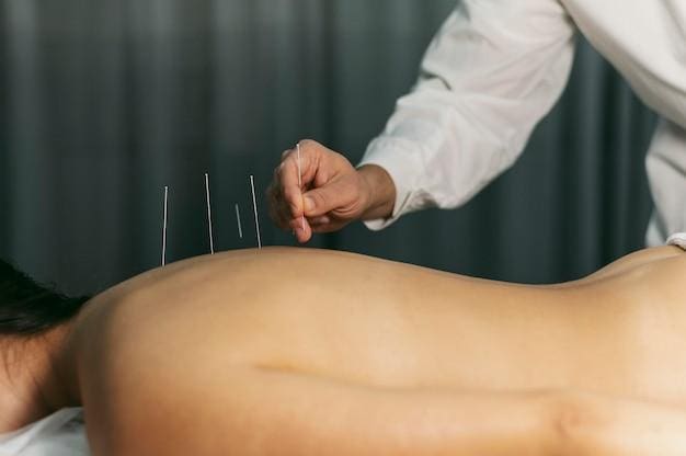 Acupuncturist applying needles to a patient's back.