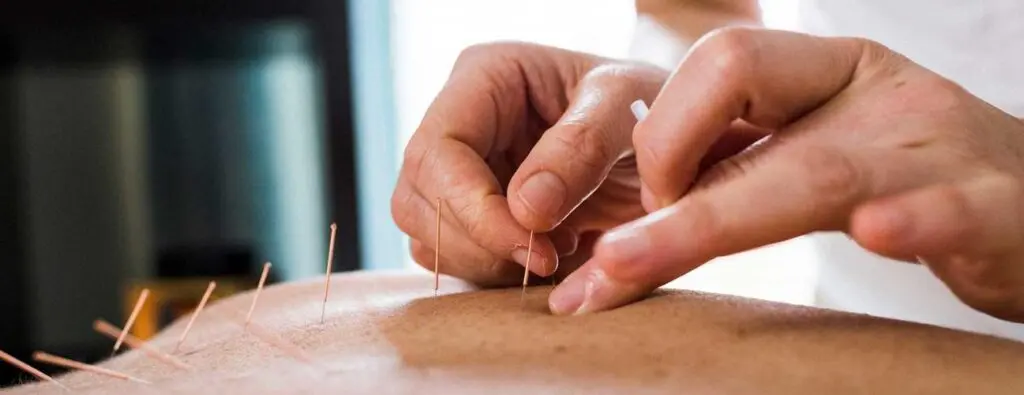 Chinese acupuncture