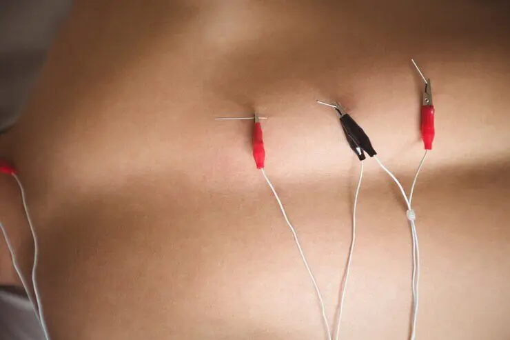 Close-up of acupuncture needles attached to wires on a person's back, possibly for electroacupuncture therapy.