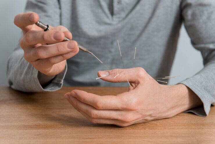 A person holds an acupuncture needle with one hand while inserting multiple needles into the fingers of their other hand, over a wooden table.