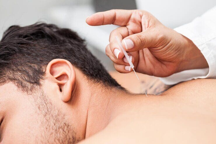 A close-up of a person receiving an acupuncture treatment, with a practitioner's hand inserting a thin needle into the back of the person's neck.