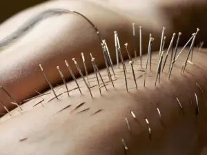 Fertility Acupuncture