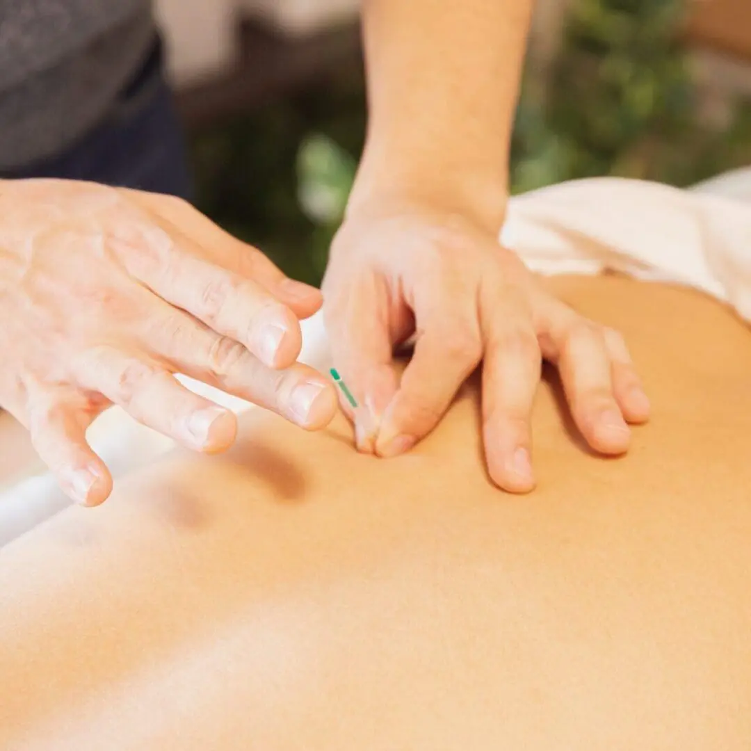 A practitioner inserts an acupuncture needle into a person's back.