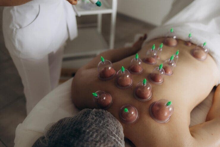 Acupuncture Treatment