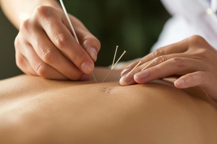 Herbal Acupuncture