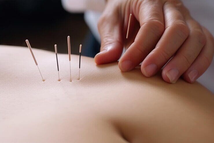 Acupuncture