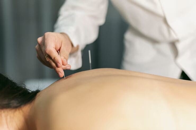 Bonafide Acupuncture | What Makes Acupressure Therapy in Manhattan So Effective for Anxiety, Depression, and Migraines? Anxiety