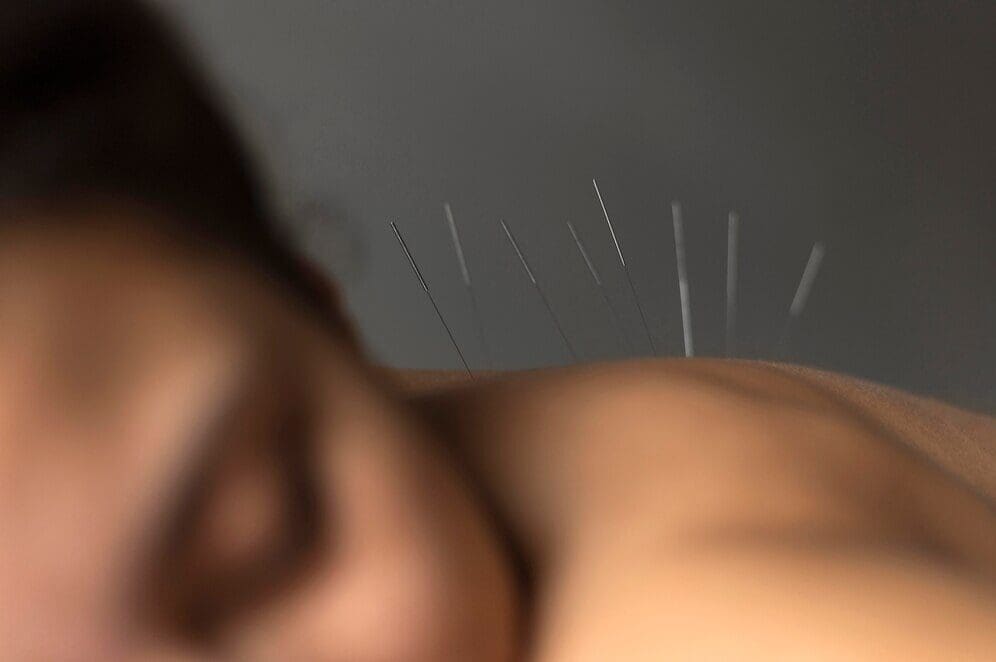 Classical Chinese Acupuncture