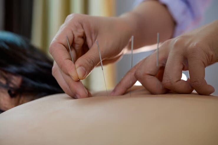 Bonafide Acupuncture | Acupuncture and the Path to Optimal Health: Integrating Ancient Practices into Your Life Long-Lasting Relief after Acupuncture