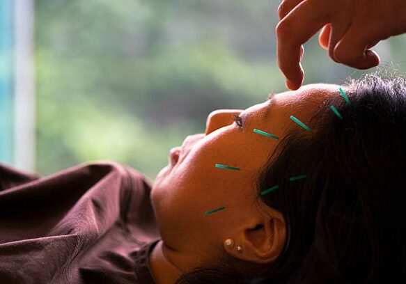 A woman in Brooklyn getting acupuncture on her head to alleviate anxiety or depression.