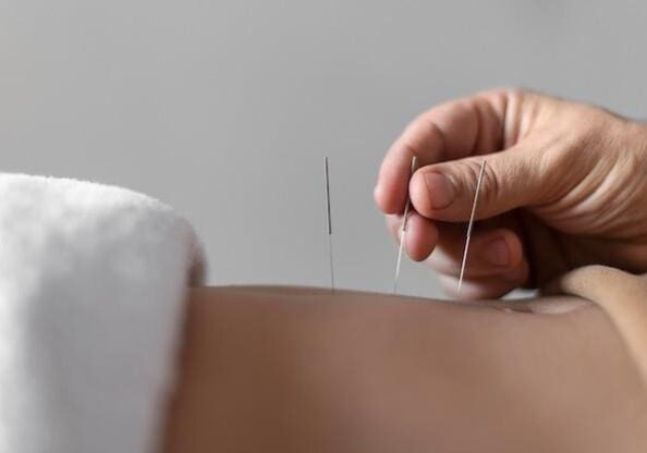 Practitioner inserting acupuncture needles into a patient's skin.