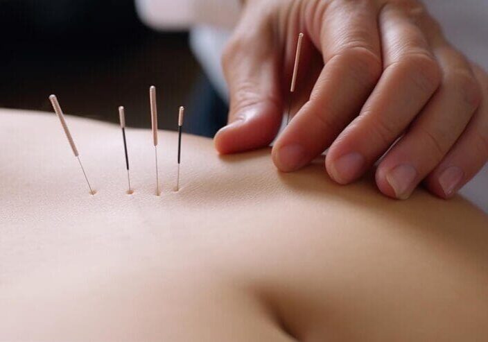 Acupuncture Acupuncture