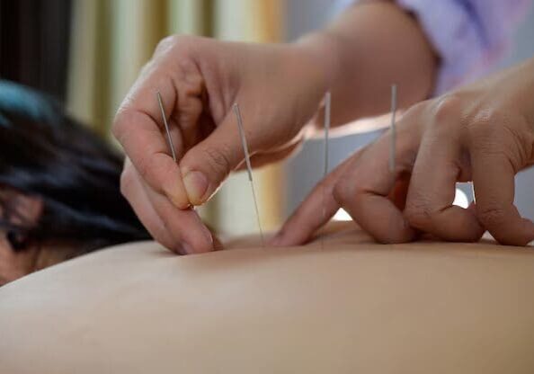 Chinese Acupuncture