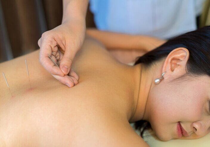 Chinese Acupuncture