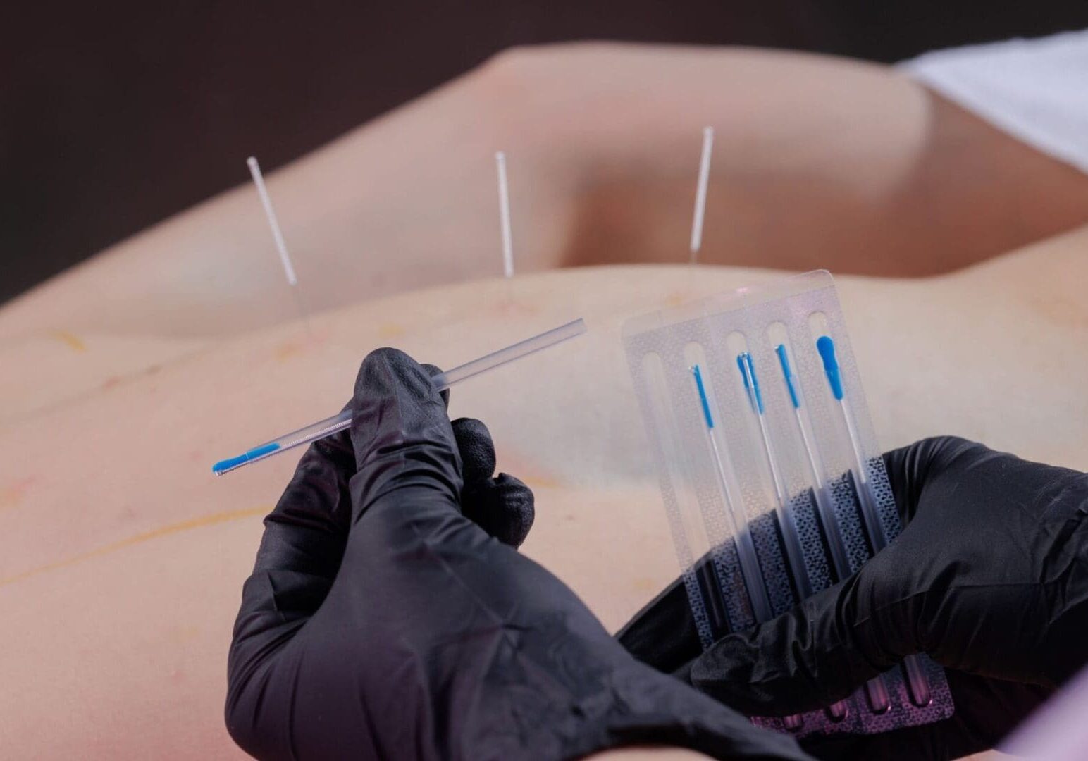 Dry needling Treatment For Back pain