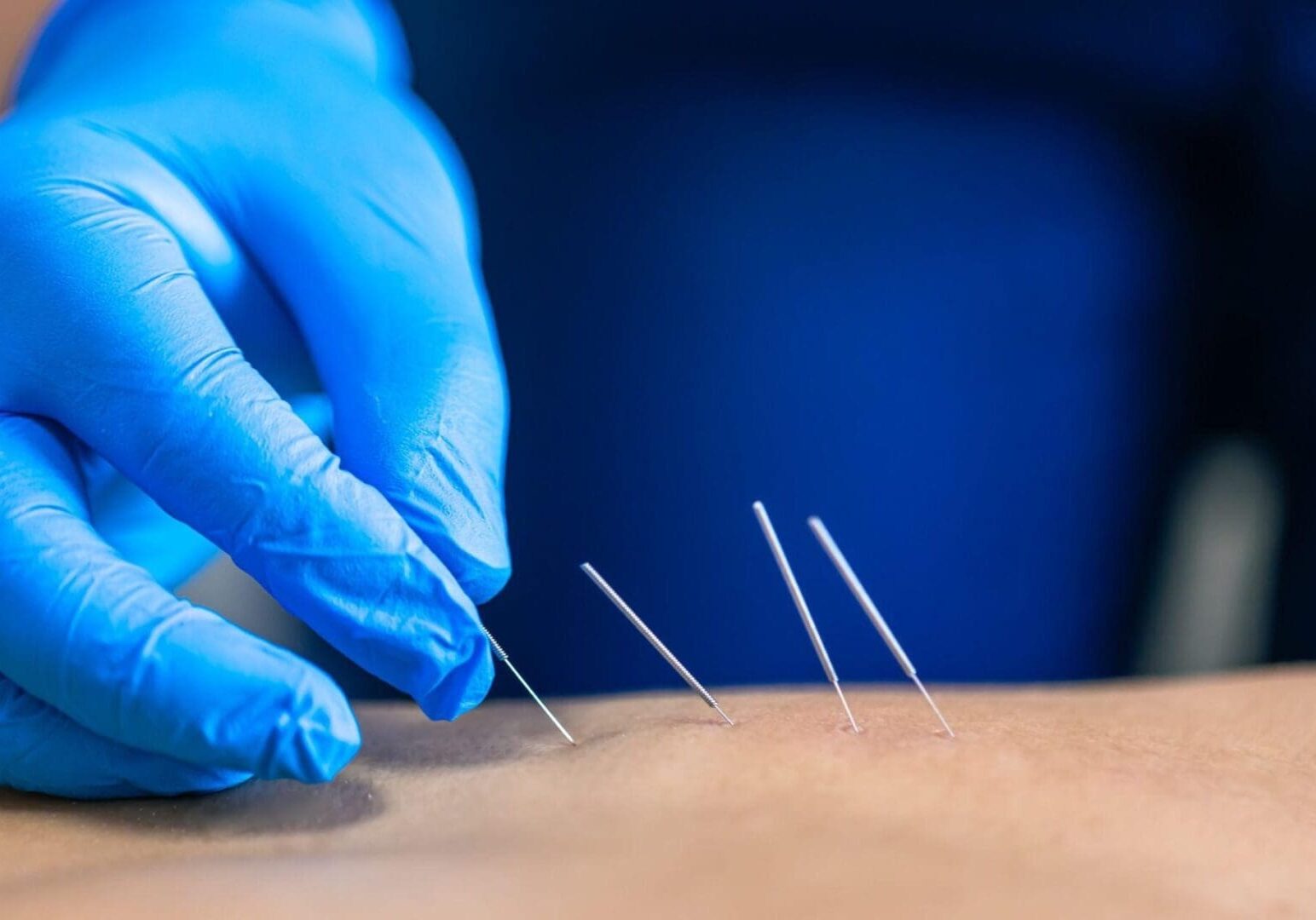 Dry needling therapy for Muscle relief