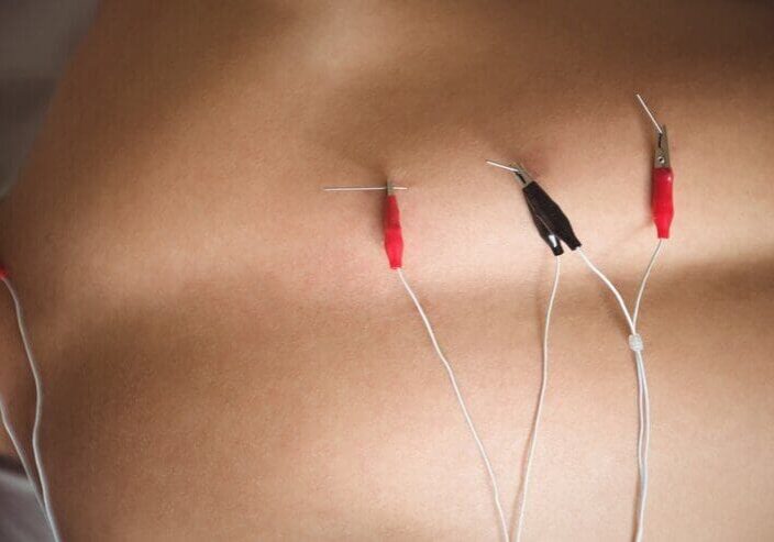 Close-up of acupuncture needles attached to wires on a person's back, possibly for electroacupuncture therapy.