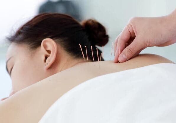 Traditional Acupuncture Traditional Acupuncture
