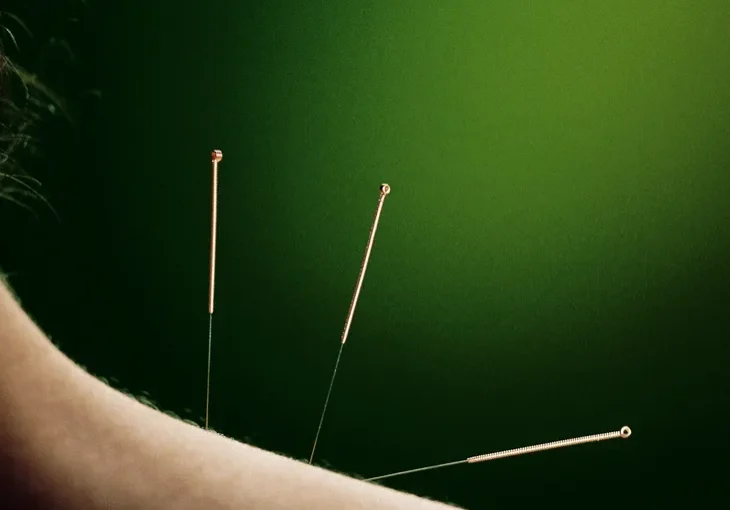 A woman receiving acupuncture in Brooklyn with needles on her back.