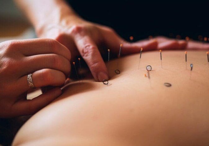 acupuncture for back pain