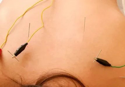 A woman with acupuncture needles on her back.