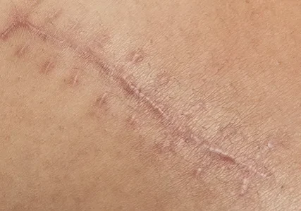 A woman's leg with a scar on it.