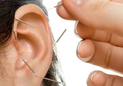 A woman is getting acupuncture on her ear.