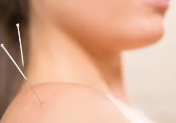 A woman with acupuncture needles on her shoulder receiving treatment for neck pain.