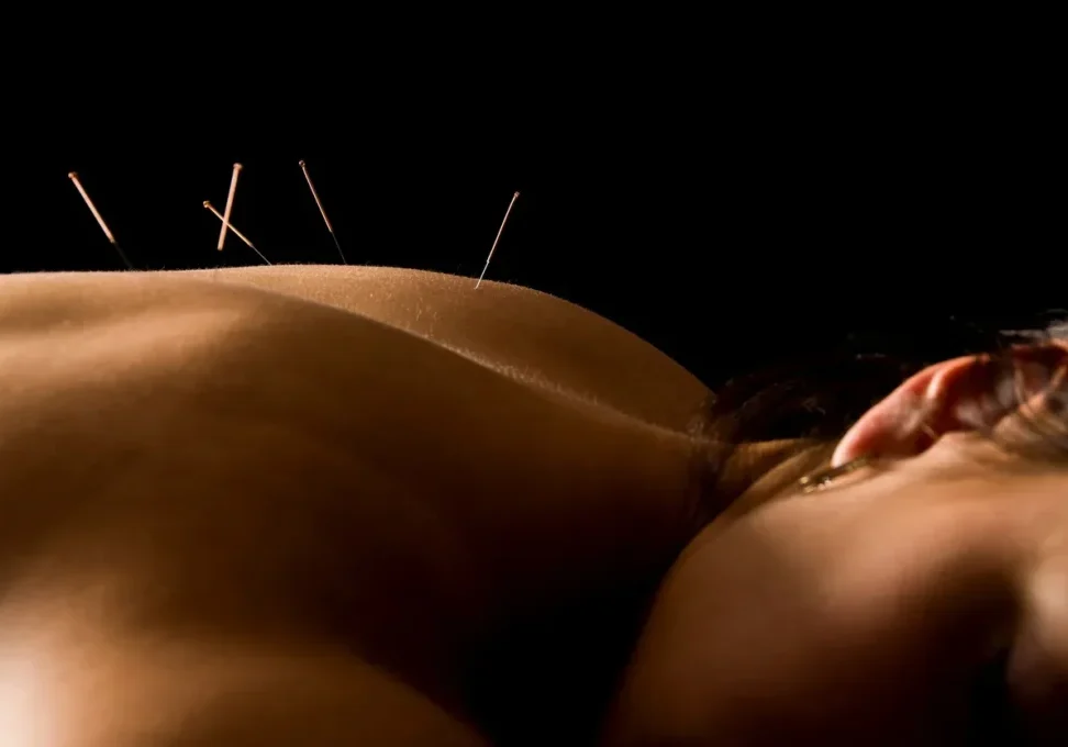A woman receiving acupuncture treatment.