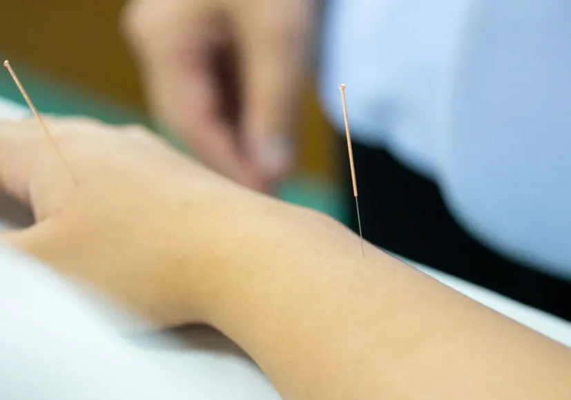 An acupuncture needle being placed on a person's arm to alleviate neuropathy.