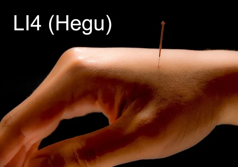 A person's hand with an acupuncture needle on it, targeting sinus pressure for relief.